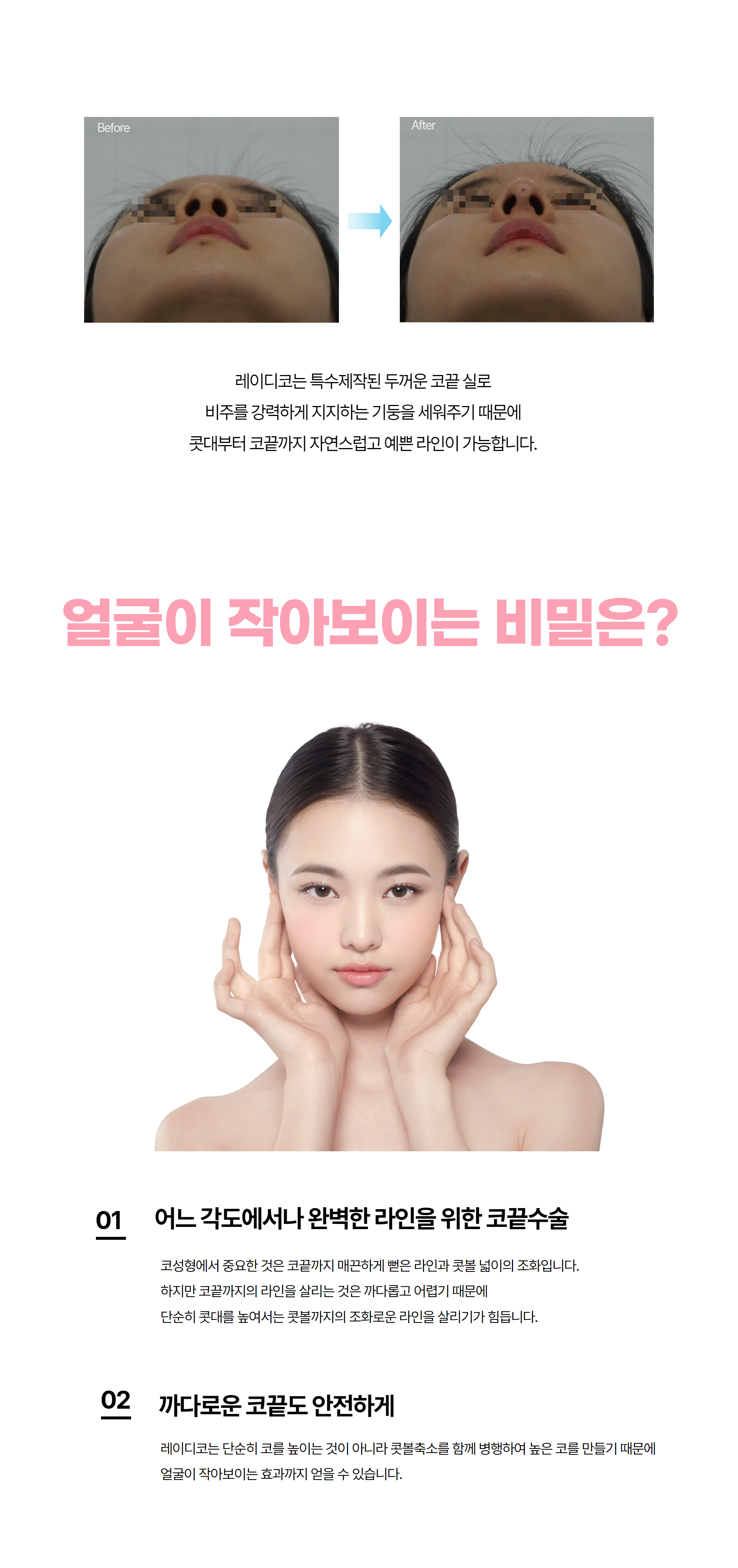 레이디코 코끝 시술 전후 비교 — Before·After, 두꺼운 코끝 실로 비주를 지지